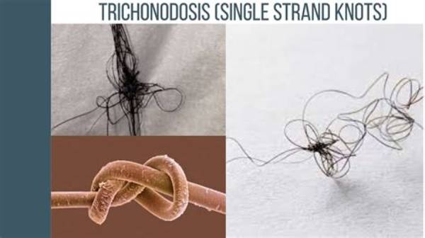 What Is Trichonodosis?