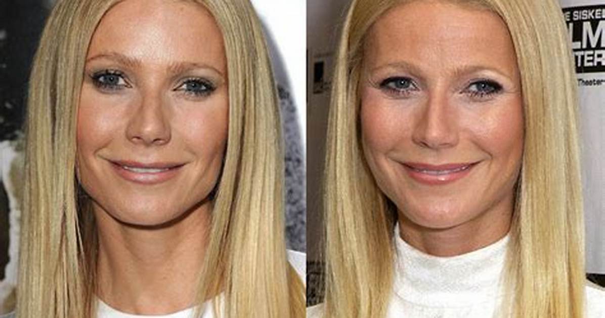 What Movie Stars Had Cataract Surgery?