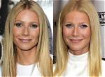What Movie Stars Had Cataract Surgery?