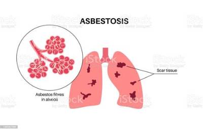 What Organs Does Asbestosis Affect?