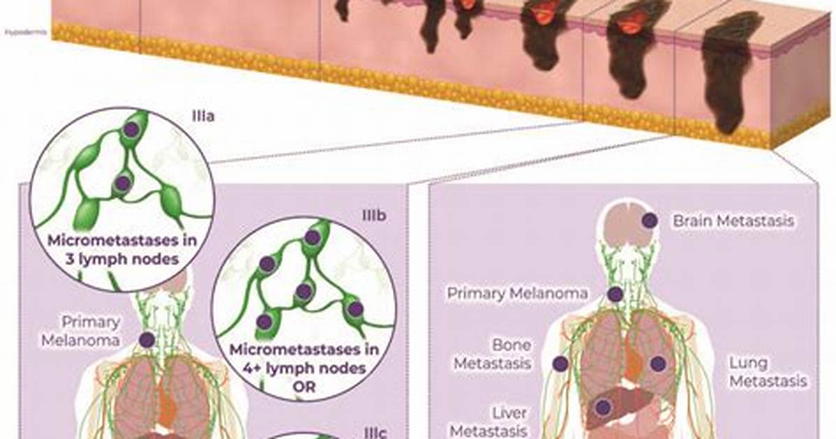What Organs Does Melanoma Affect?