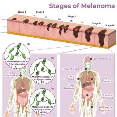 What Organs Does Melanoma Affect?