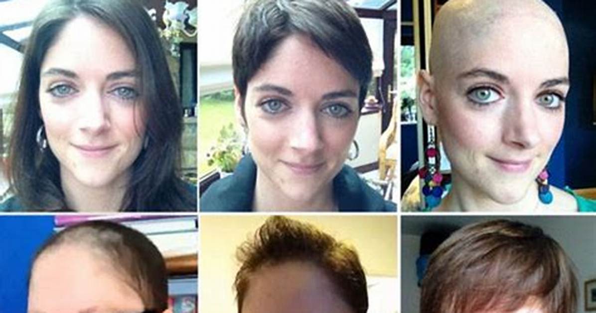 What Percentage of Chemo Patients Lose Their Hair?