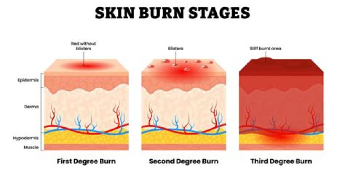 What S a Second Degree Burn Look