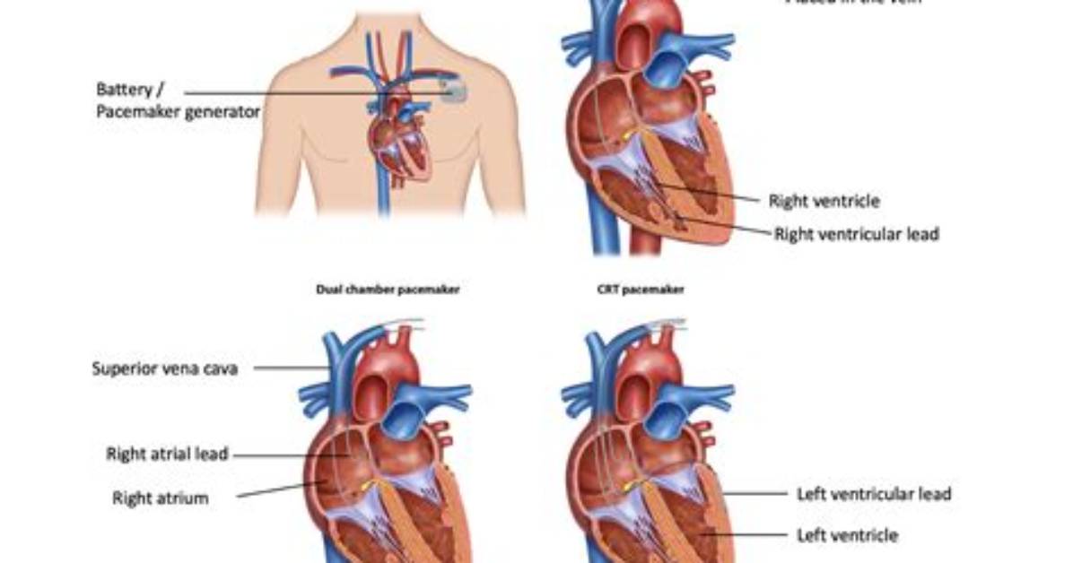 What's the Difference Between a Pacemaker and a Defibrillator?