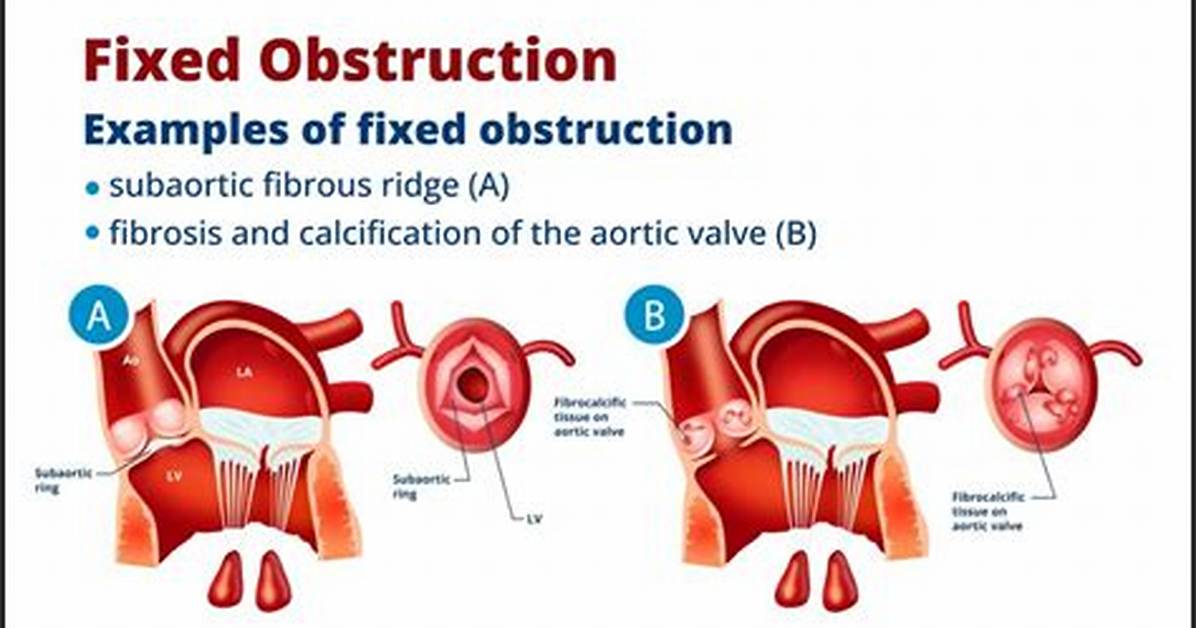 What's the Difference Between Obstruction and Interference?