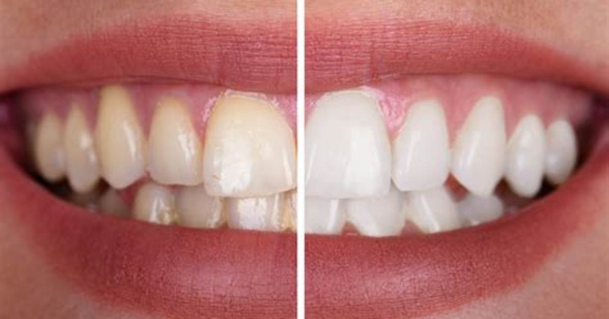What Should You Not Do After Bleaching?
