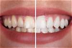 What Should You Not Do After Bleaching?