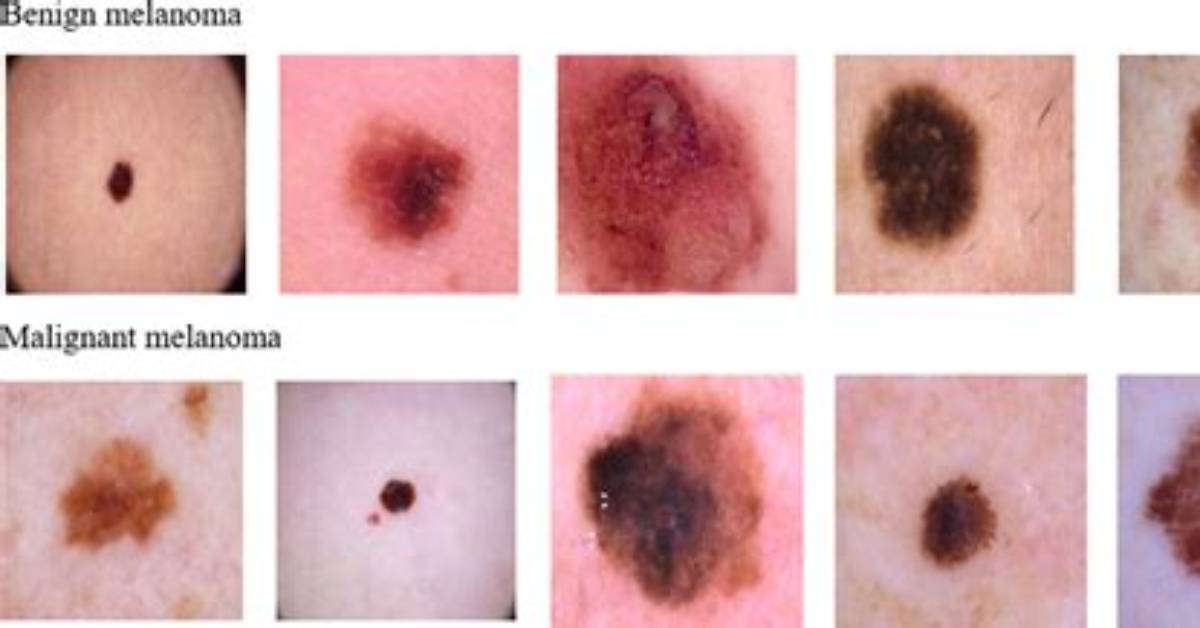 What Type of Melanoma Is Benign?