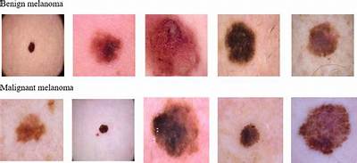 What Type of Melanoma Is Benign?