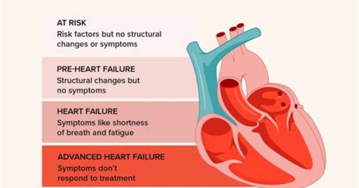 What Were Your First Signs of Chf?