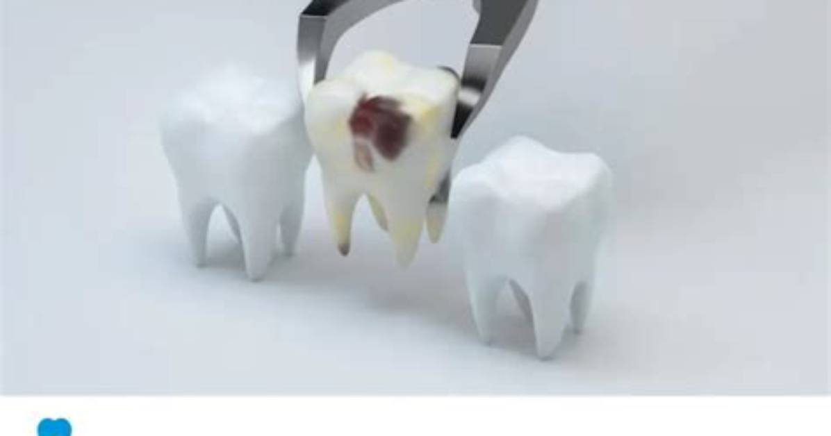 When Can I Eat a Cheeseburger After Tooth Extraction?
