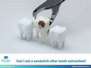 When Can I Eat a Cheeseburger After Tooth Extraction?