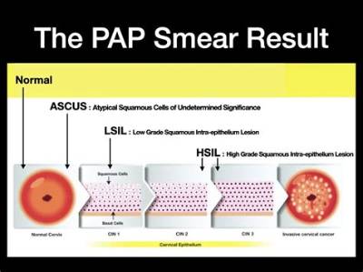 When Do You Repeat Pap Ascus and Negative Hpv?
