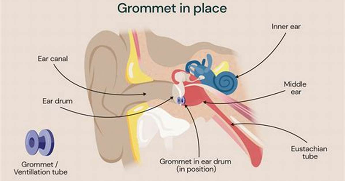 When Grommets Fall out Does It Hurt?