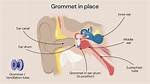 When Grommets Fall out Does It Hurt?