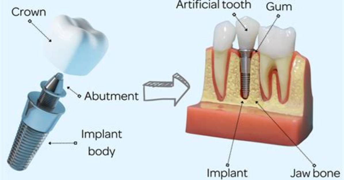 When Is the Abutment Placed?