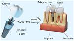 When Is the Abutment Placed?