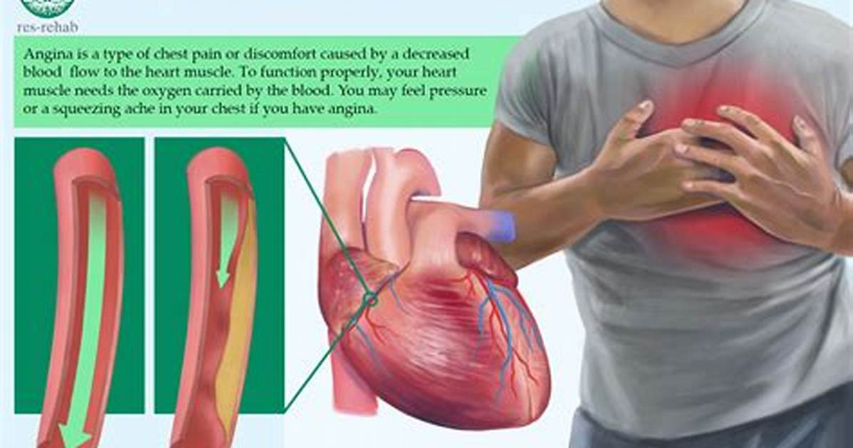 Where Is Angina Pain Located?