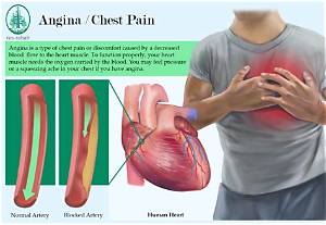 Where Is Angina Pain Located?