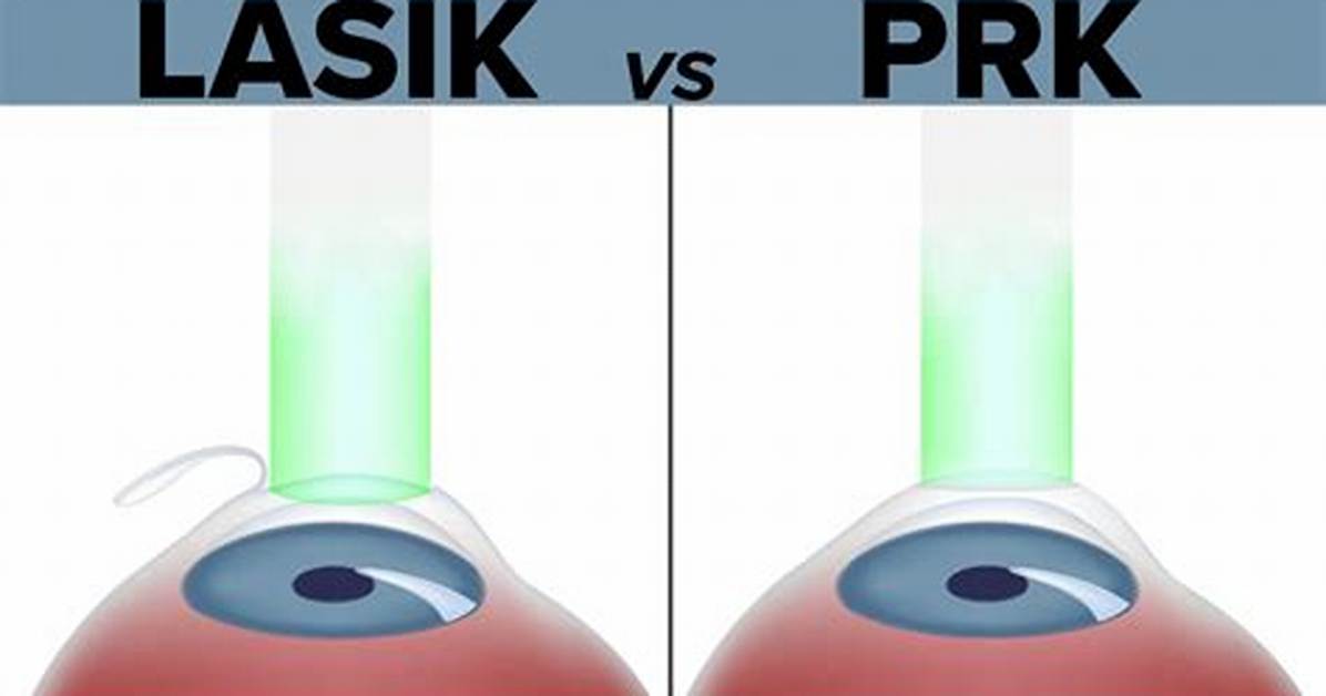 Which Is Cheaper Lasik or Prk?