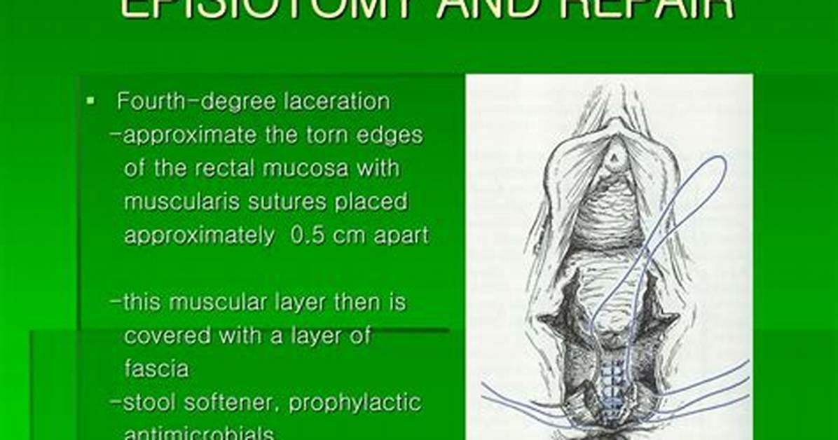Which Is Worse Episiotomy or Tear?