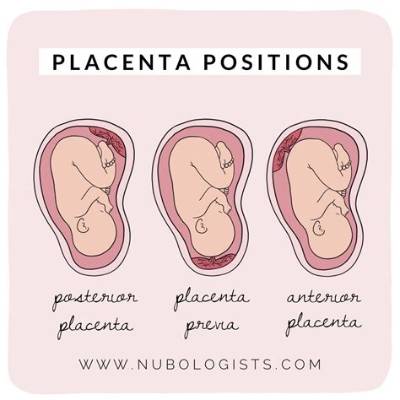 Which Placenta Position Is Best?