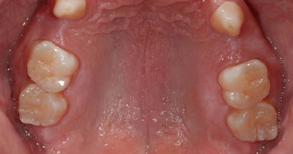 Which Teeth Are Sometimes Congenitally Missing?