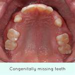 Which Teeth Are Sometimes Congenitally Missing?