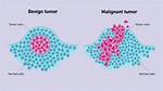 Which Tumor Is Painful Benign or Malignant?