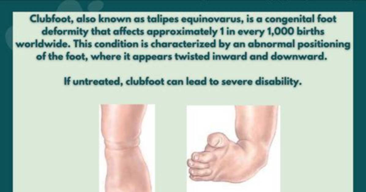 Who Has a Clubfoot?