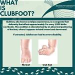 Who Has a Clubfoot?