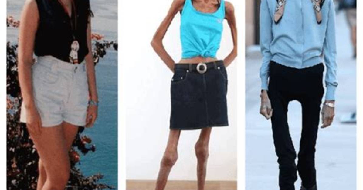 Who Is the Most Skinniest Person in the World? Unveiling the Incredible Story