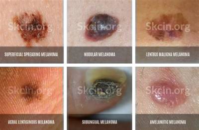 Who Removes a Melanoma?