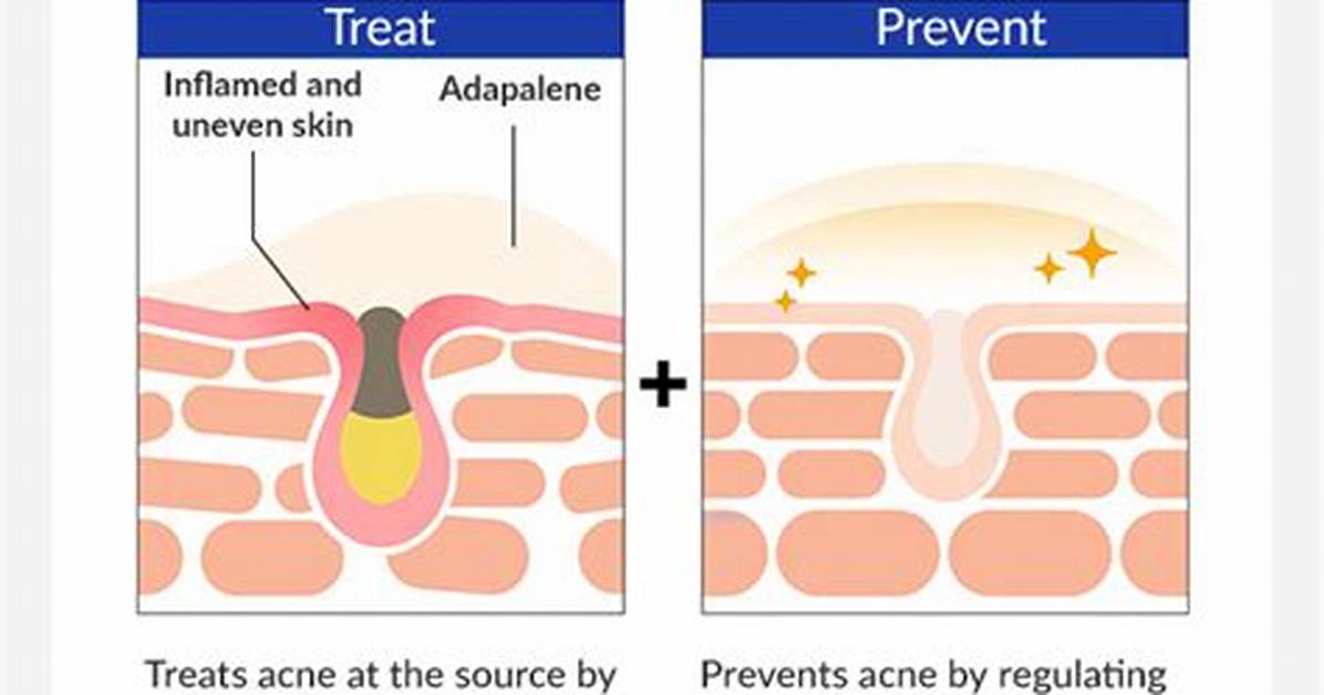 Who Should Use Adapalene?