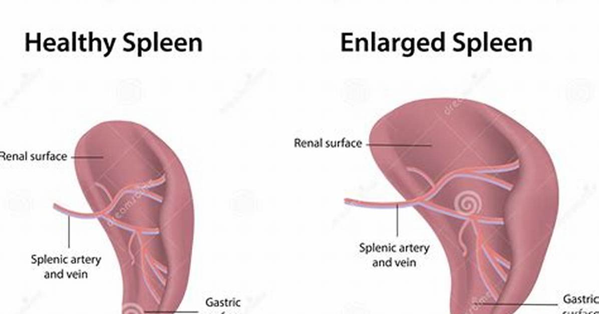Who Treats Splenomegaly?
