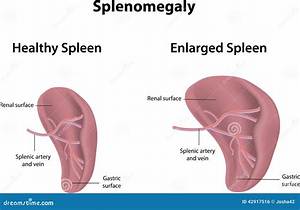 Who Treats Splenomegaly?