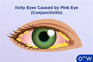 Why Are My Eyes Itchy?