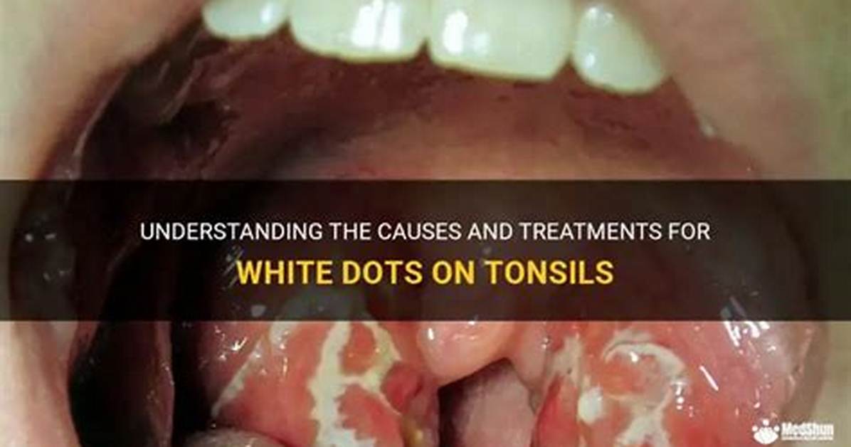 Why Are My Tonsils White?