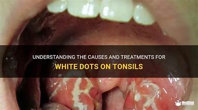 Why Are My Tonsils White?