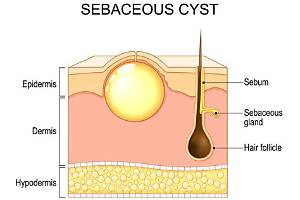 Why Do I Have a Cyst on My Toe?