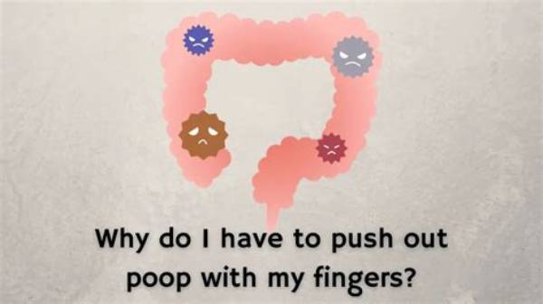 Why Do I Have to Push My Poop out with My Fingers?