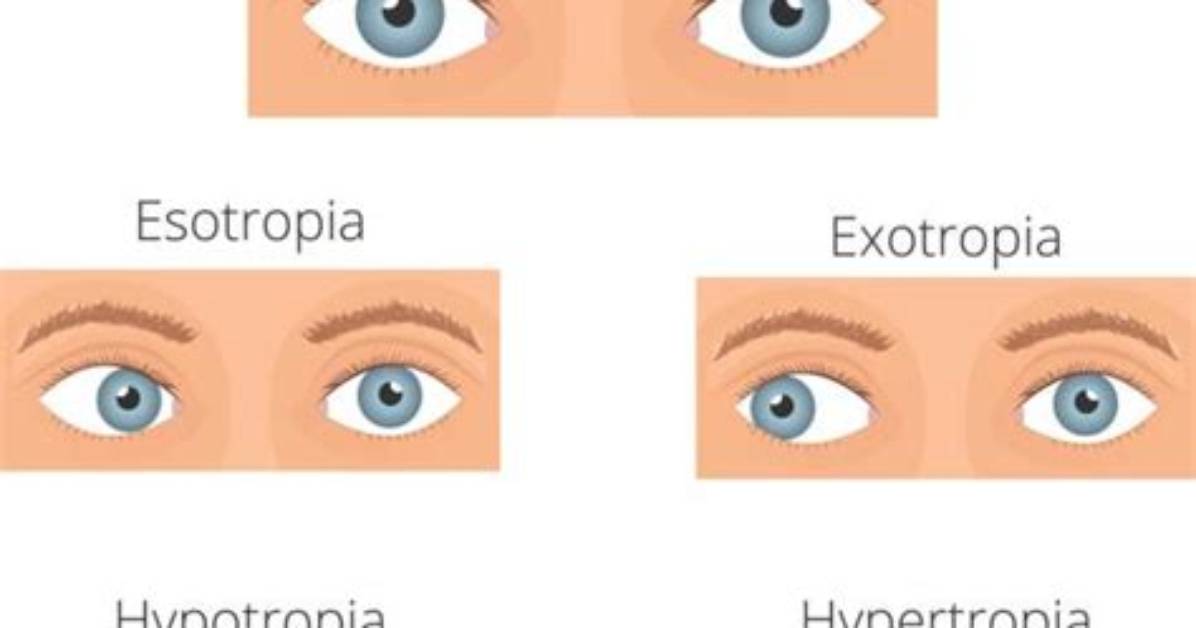 Why Do I Wake up Cross-Eyed?