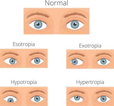 Why Do I Wake up Cross-Eyed?