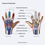 Why Do My Hands Hurt When I Hit a Softball?