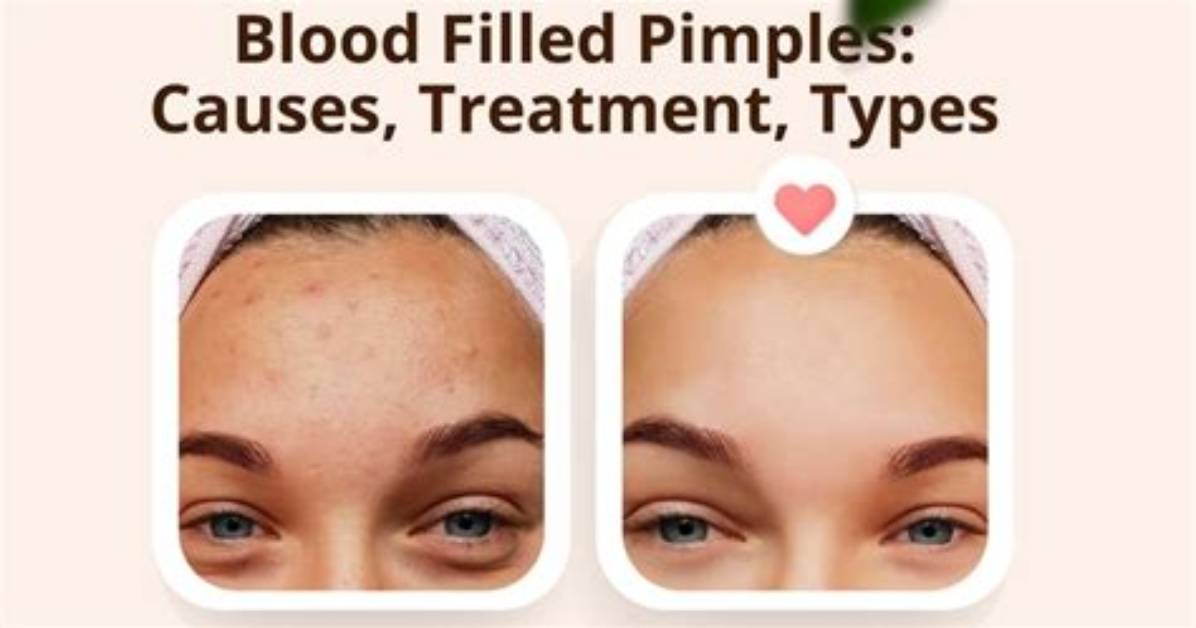Why Do Pimples Bleed?
