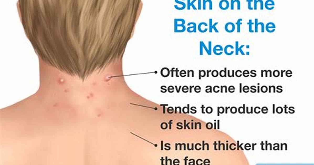 Why Do Some Zits Have a Seed?