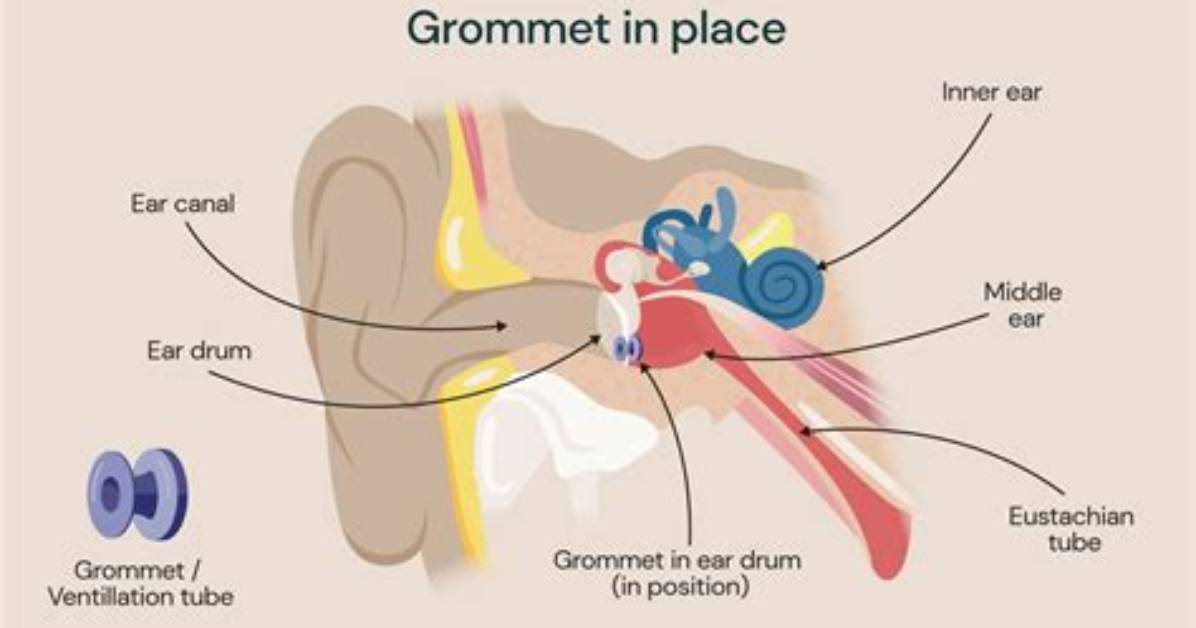 Why Do They Put Grommets in Ears?