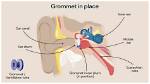 Why Do They Put Grommets in Ears?