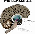 Why Does Chlorpromazine Causes Parkinson's Disease?